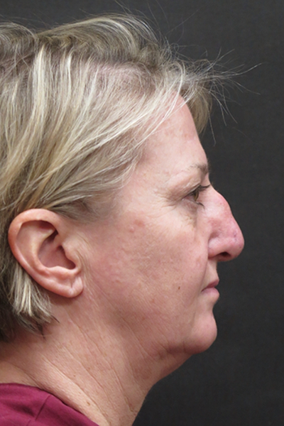 Rhinoplasty Before & After Patient #2826