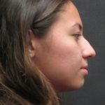 Rhinoplasty Before & After Patient #2798