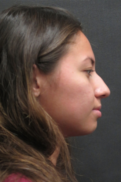 Rhinoplasty Before & After Patient #2798