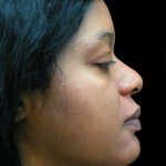 Rhinoplasty Before & After Patient #2812