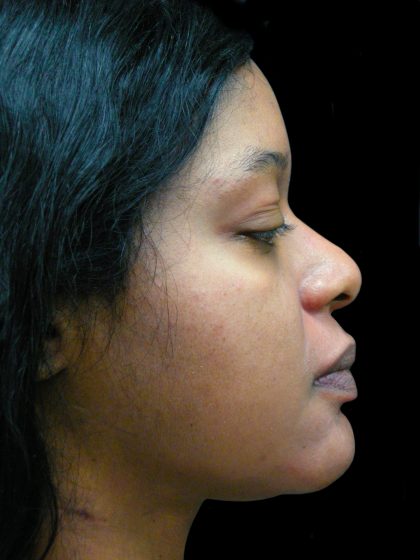 Rhinoplasty Before & After Patient #2812