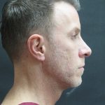 Rhinoplasty Before & After Patient #2870