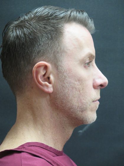 Rhinoplasty Before & After Patient #2870
