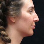 Rhinoplasty Before & After Patient #2851