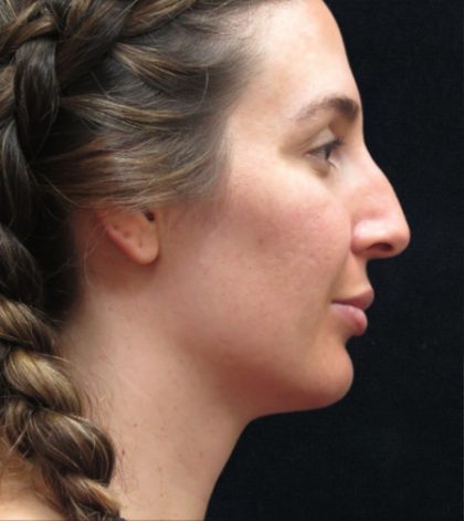 Rhinoplasty Before & After Patient #2851