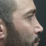 Rhinoplasty Before & After Patient #2884
