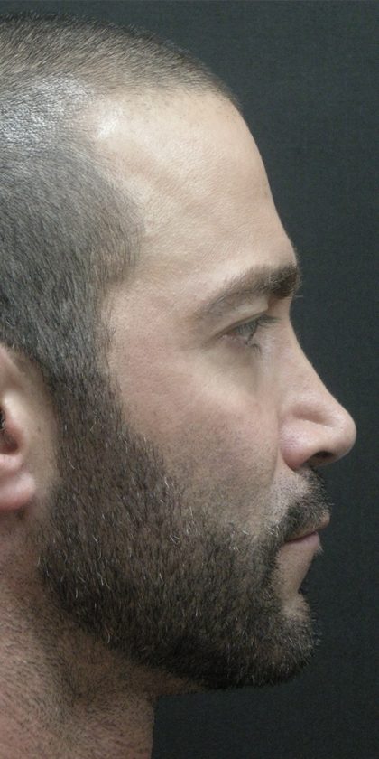 Rhinoplasty Before & After Patient #2884