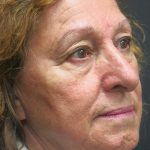 Rhinoplasty Before & After Patient #2891