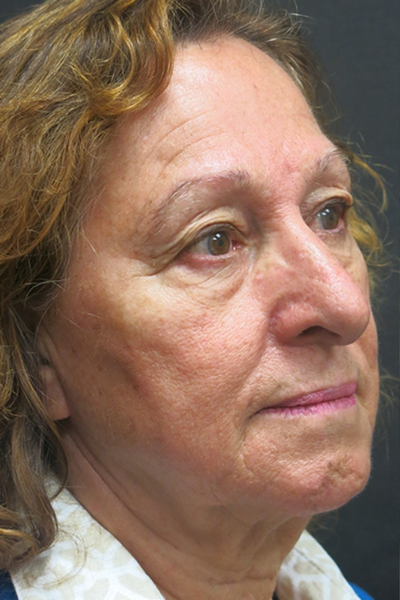 Rhinoplasty Before & After Patient #2891