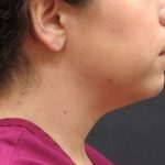 Chin Augmentation Before & After Patient #1561