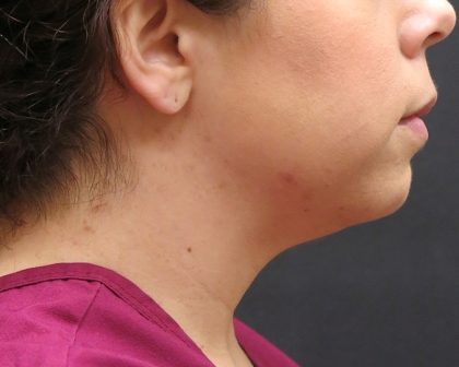 Chin Augmentation Before & After Patient #1561