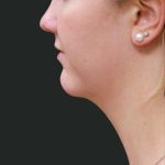 Fat Transfer Before & After Patient #1782