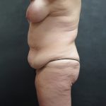 Mommy Makeover Before & After Patient #2542