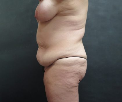 Mommy Makeover Before & After Patient #2542