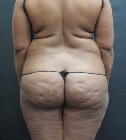 Mommy Makeover Before & After Patient #2618