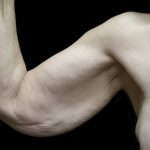 Arm Lift Before & After Patient #904