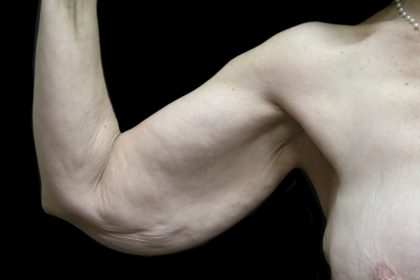 Arm Lift Before & After Patient #904