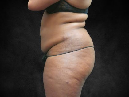 Mommy Makeover Before & After Patient #2587