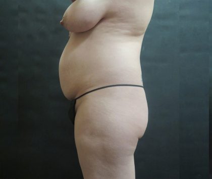 Mommy Makeover Before & After Patient #2563