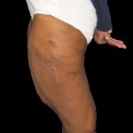 Thigh Lift Before & After Patient #3137