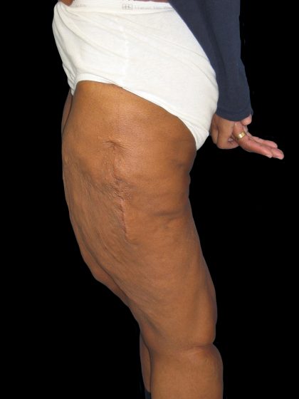 Thigh Lift Before & After Patient #3137