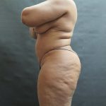 BBL / Brazilian Butt Lift / Gluteal Fat transfer Before & After Patient #1530