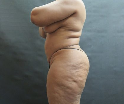 BBL / Brazilian Butt Lift / Gluteal Fat transfer Before & After Patient #1530