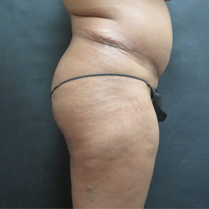 BBL / Brazilian Butt Lift / Gluteal Fat transfer Before & After Patient #1506