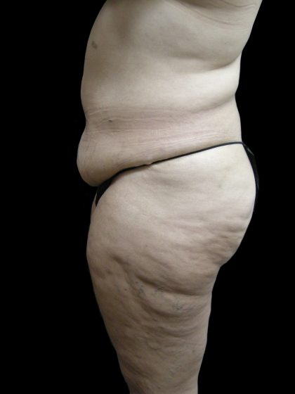 Post Weight Loss Before & After Patient #2791