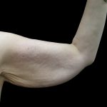 Arm Lift Before & After Patient #897