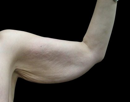 Arm Lift Before & After Patient #897