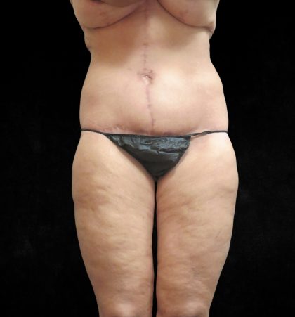 Lower Body Lift Before & After Patient #2262