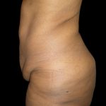 Lower Body Lift Before & After Patient #2327
