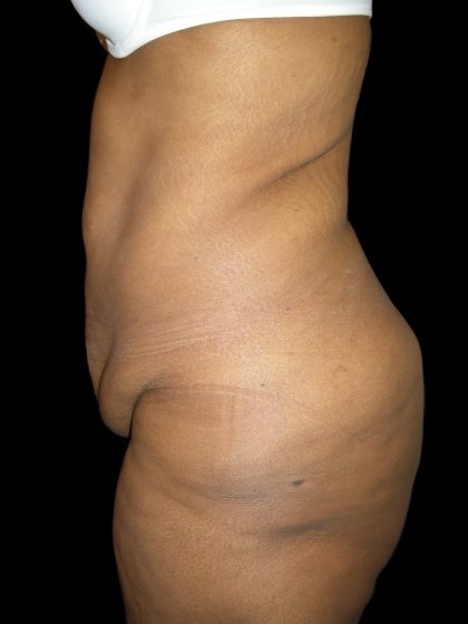 Lower Body Lift Before & After Patient #2327