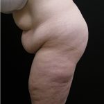 Lower Body Lift Before & After Patient #2285