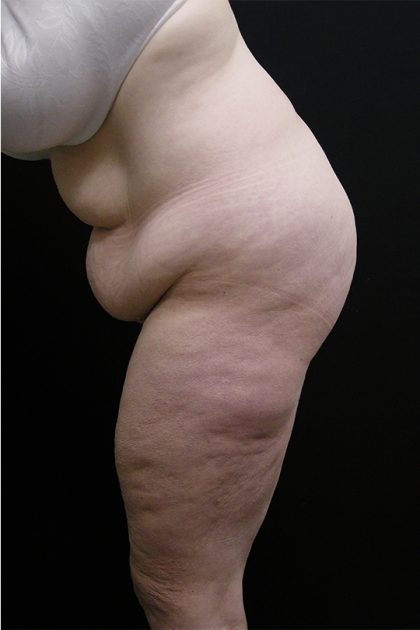 Lower Body Lift Before & After Patient #2285