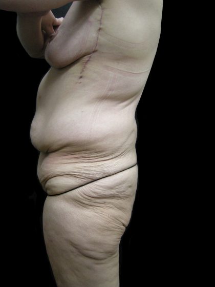 Lower Body Lift Before & After Patient #2305