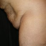 Lower Body Lift Before & After Patient #2269