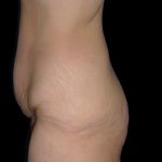Lower Body Lift Before & After Patient #2278