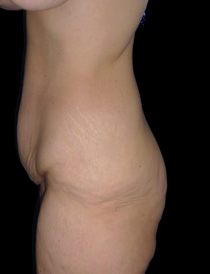 Lower Body Lift Before & After Patient #2278