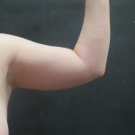 Liposuction Before & After Patient #936