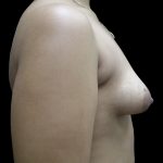 Breast Asymmetry Before & After Patient #965