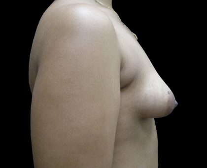 Breast Asymmetry Before & After Patient #965