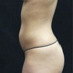 Mommy Makeover Before & After Patient #2520