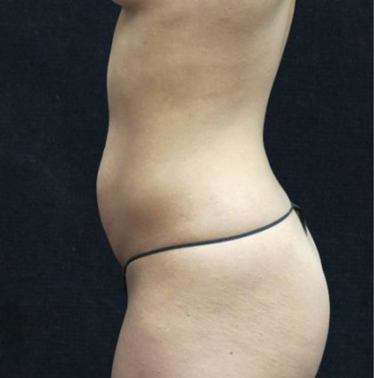 Mommy Makeover Before & After Patient #2520