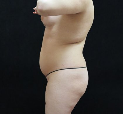 Mommy Makeover Before & After Patient #2596