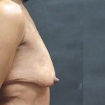 Breast Lift Before & After Patient #1244