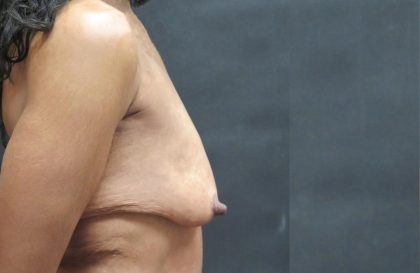 Breast Lift Before & After Patient #1244