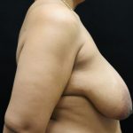 Breast Lift Before & After Patient #1286