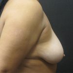 Breast Lift Before & After Patient #1237